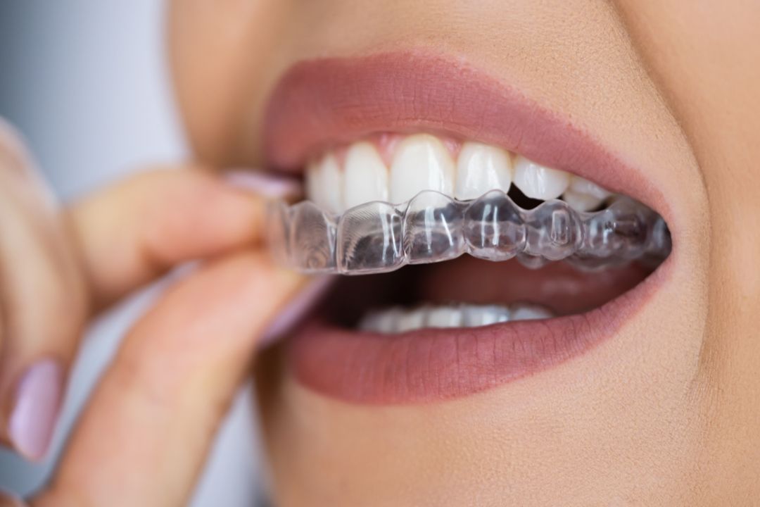 Digital Dental Scan