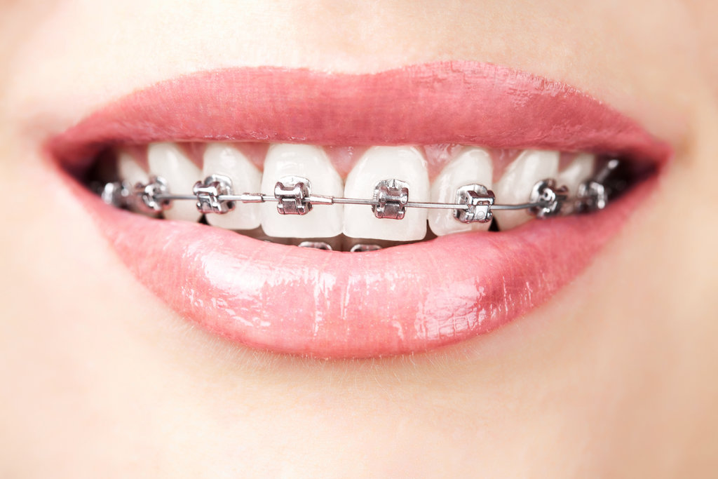 Dental Braces