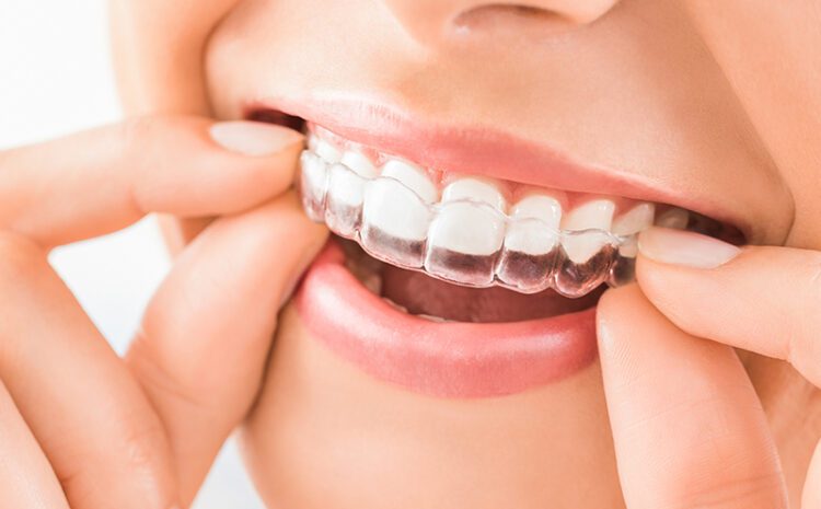 Clear Aligners