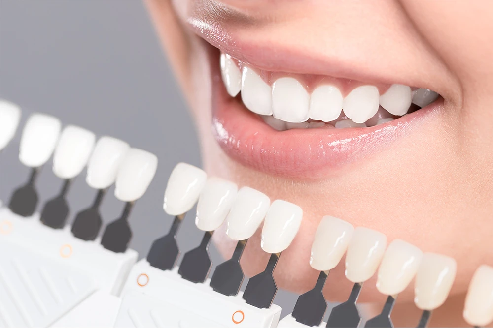 Natural Tooth Shade Matching