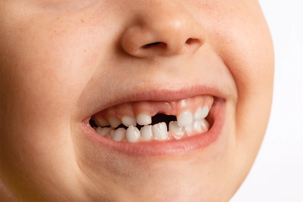 Repair of Chipped or Broken Teeth