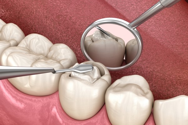 Mercury-Free Fillings