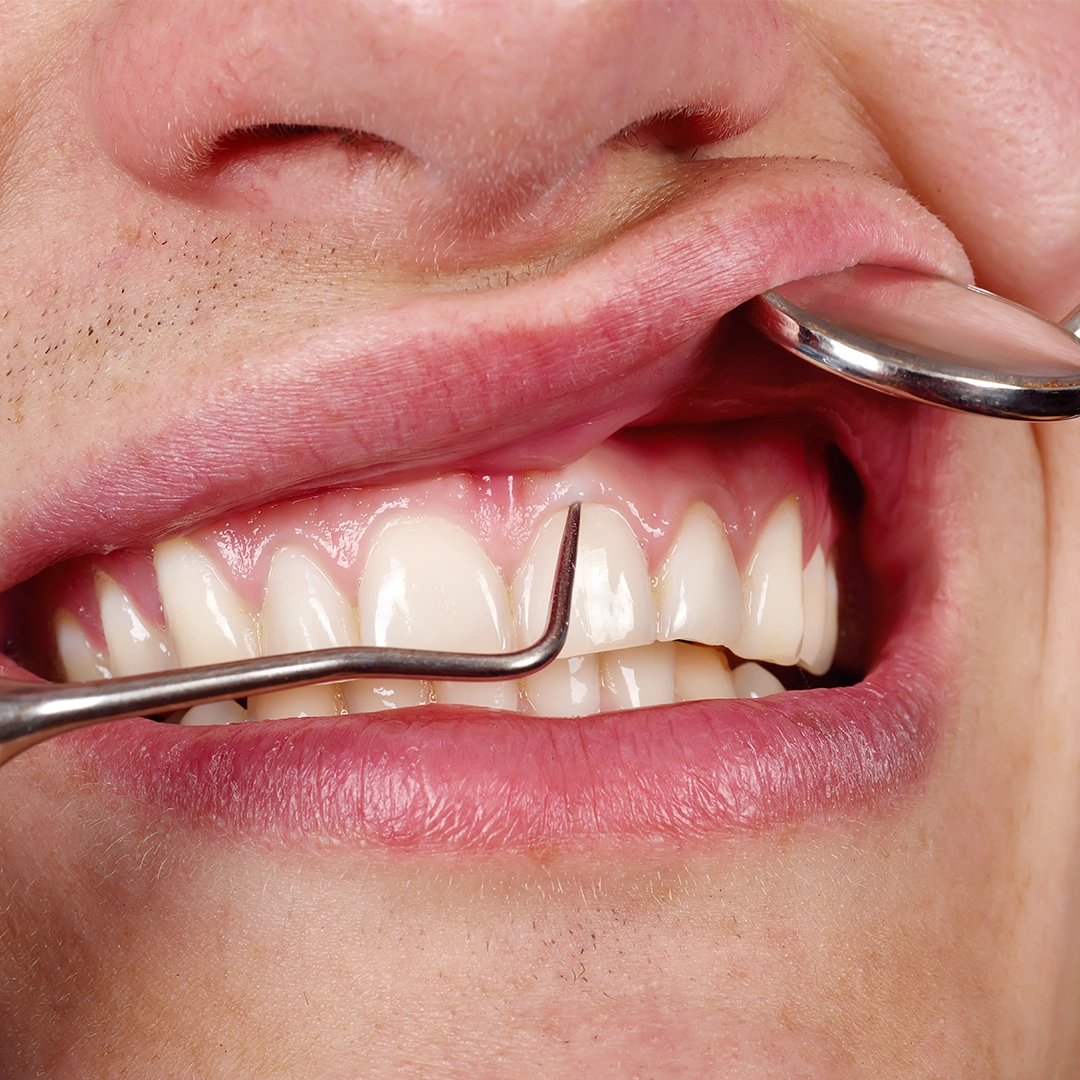 Symmetrical Perfect Smile