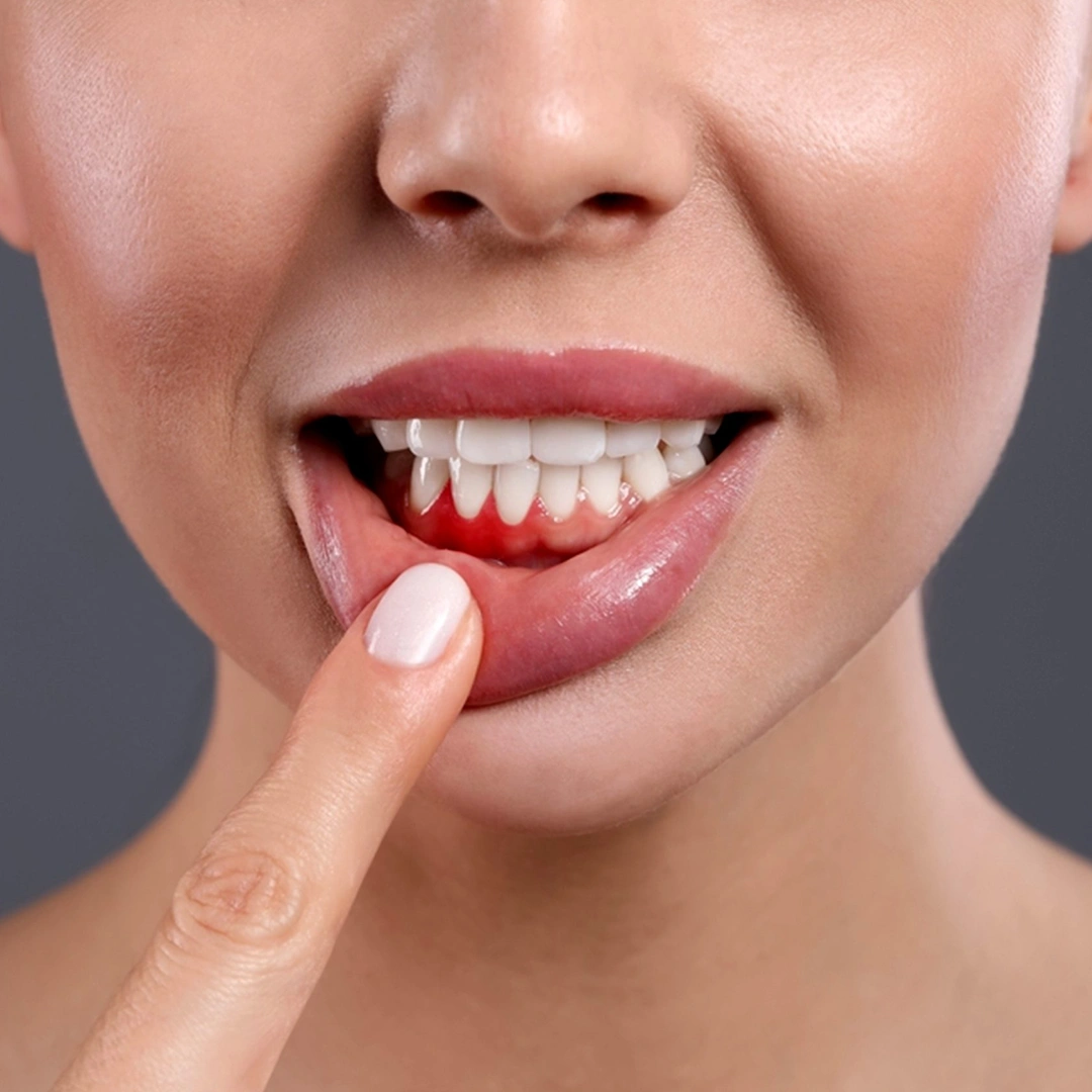 Gum Whitening