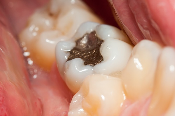 Cavity Prevention