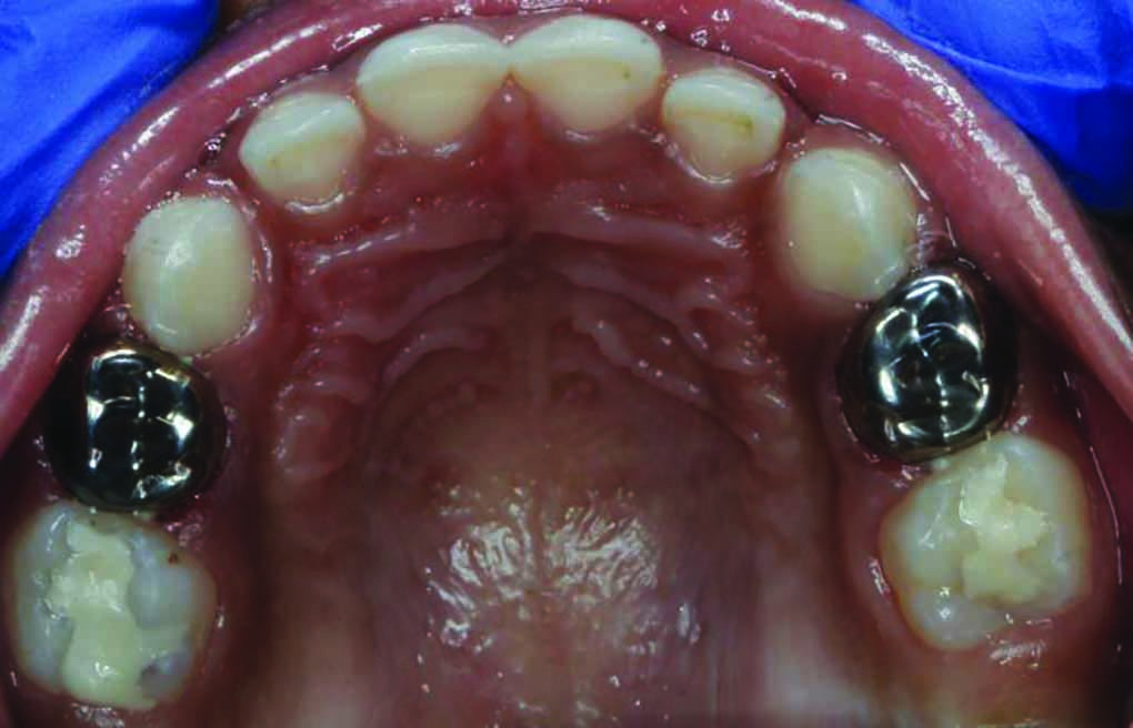 Zirconia Crowns