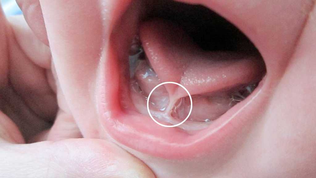 Infant Care and Frenectomy